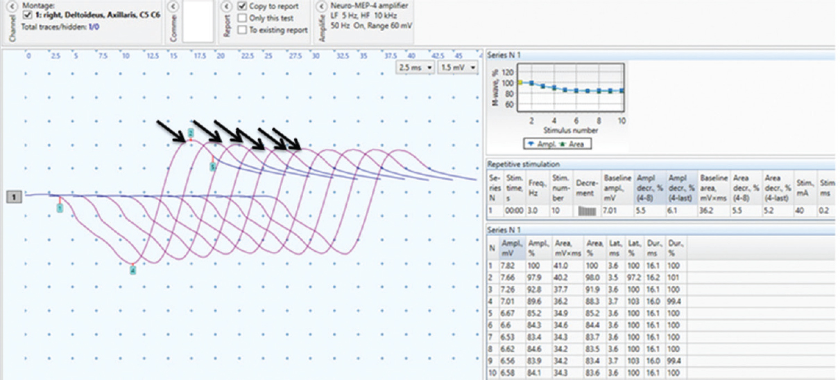 Repetitive nerve stimulation test of the right deltoid muscle done at baseline at 3 Hz showing characteristic decremental response up to 17 per cent (arrows) and repair occurring after seventh wave suggestive of post-synaptic neurotransmission defect.